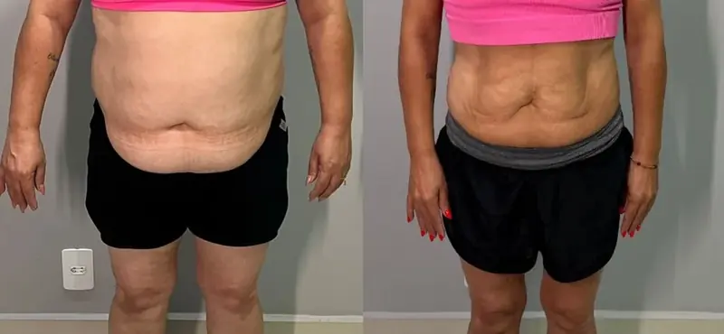 Antes e depois de emagrecimento, paciente de frente