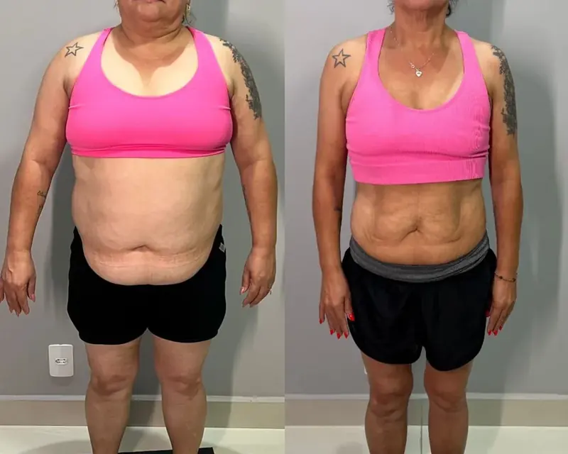 Antes e depois de emagrecimento, paciente de frente